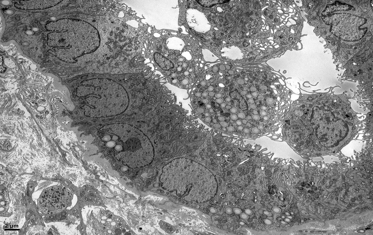 John Brealey (@johnbrealey) on Twitter photo Native kidney bx of a 50M w psoriasis. @electronmicroscopy shows membranous nephropathy (MN). Is there a relationship between psoriasis and MN? Could there be a PLA2 receptor auto-antibody that attacks both keratinocytes in skin + podocytes in glomeruli? <a href="/SethiRenalPath/">Sanjeev Sethi</a> #askrenal Native kidney bx of a 50M w psoriasis. @electronmicroscopy shows membranous nephropathy (MN). Is there a relationship between psoriasis and MN? Could there be a PLA2 receptor auto-antibody that attacks both keratinocytes in skin + podocytes in glomeruli? <a href="/SethiRenalPath/">Sanjeev Sethi</a> #askrenal