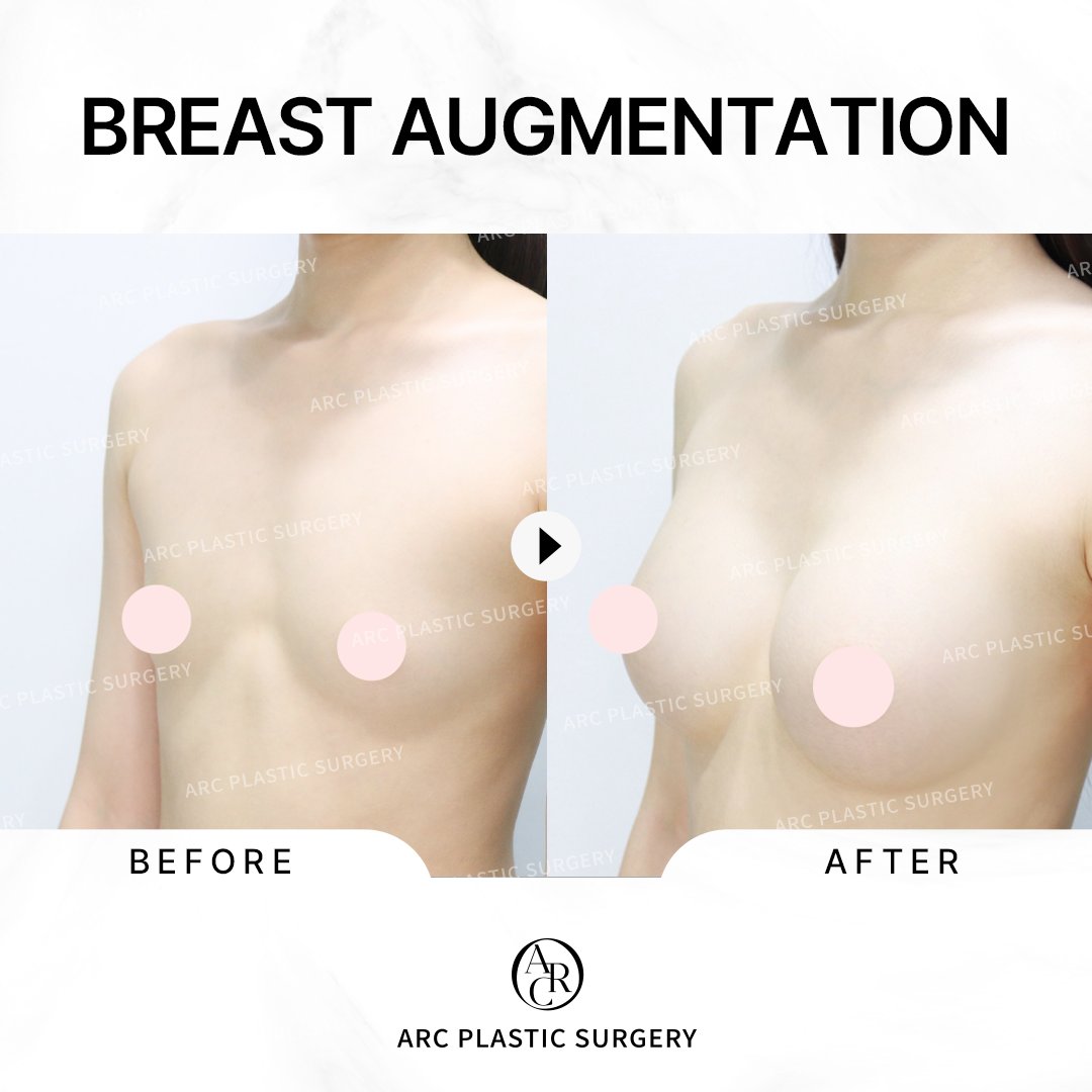 dr_kwonsoonbeom's tweet photo. [FINE ARC]
Breast Augmentation Surgery
***********
Sebbin Sublimity Implant
: LS70 Profile
- Both) 300cc
- Axillary incision
***********
#arcplasticsurgery #drkwonsoonbeom #koreaplasticsurgery #아크성형외과 #アーク整形外科 
#breastaugmentation https://t.co/OGMsXKK5zp