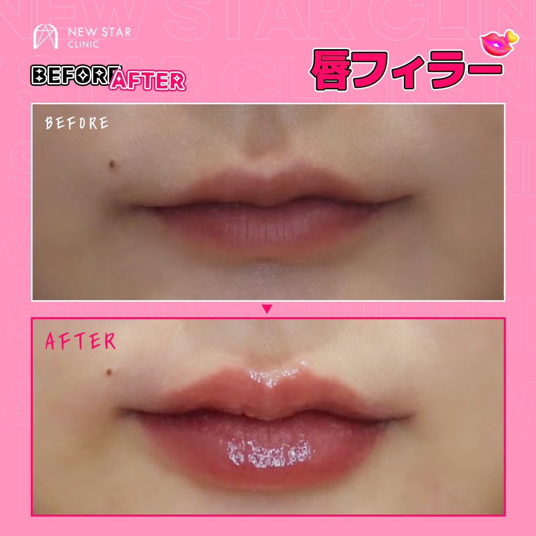 newstar_jp's tweet photo. バランスの良い唇に改善し顔全体の雰囲気を変えちゃいましょう🩷

＜お客様お悩みポイント＞
薄く存在感のない唇💦
左右幅・口角の非対称さ💦

お客様のお悩みと希望のデザインへの理解が高いニュースターだからこそ満足度の高い唇に仕上げることができます☝🏻🤍

【現在唇フィラーイベント開催中】
イベント期間残り僅かとなっております❗️
詳細は引用からチェック✅

#唇フィラー #額フィラー #目の下フィラー #口角フィラー #口角ボトックス #おでこフィラー #整形垢 #韓国美容整形 #韓国整形