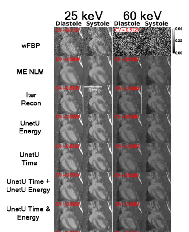 Our latest work on fast denoising for 5D (3D+Time+Energy) preclinical cardiac #PhotonCountingCT demonstrates a 32x speedup using #DeepLearning over iterative recon methods. Read more: Nadkarni et al., 2024, Phys. Med. Biol. doi.org/10.1088/1361-6…
#QIAL #MedicalImaging #CardiacCT