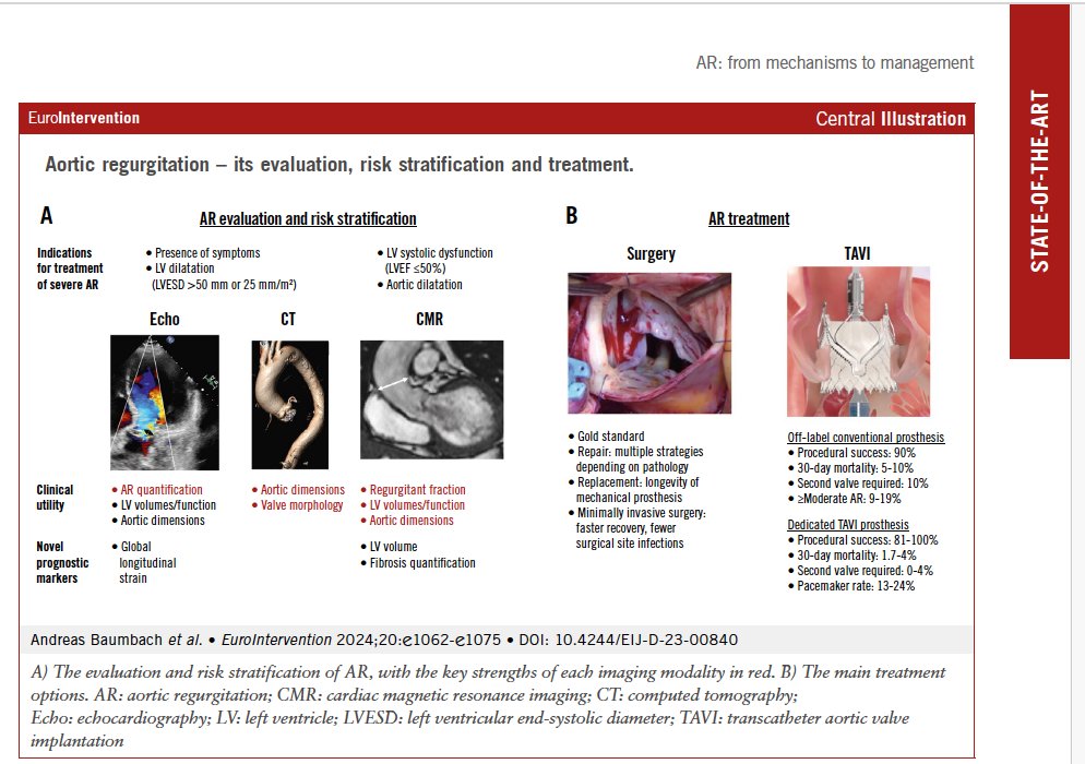 Aortic regurgitation: from mechanisms to management by Baumbach A, et al.
Explore the latest in AR diagnosis, treatment, and emerging therapies. #EAPCI #Aorticregurgitation #cardiotwitter #medicalresearch #structuralcardiology
ow.ly/kBGj50TeiJJ