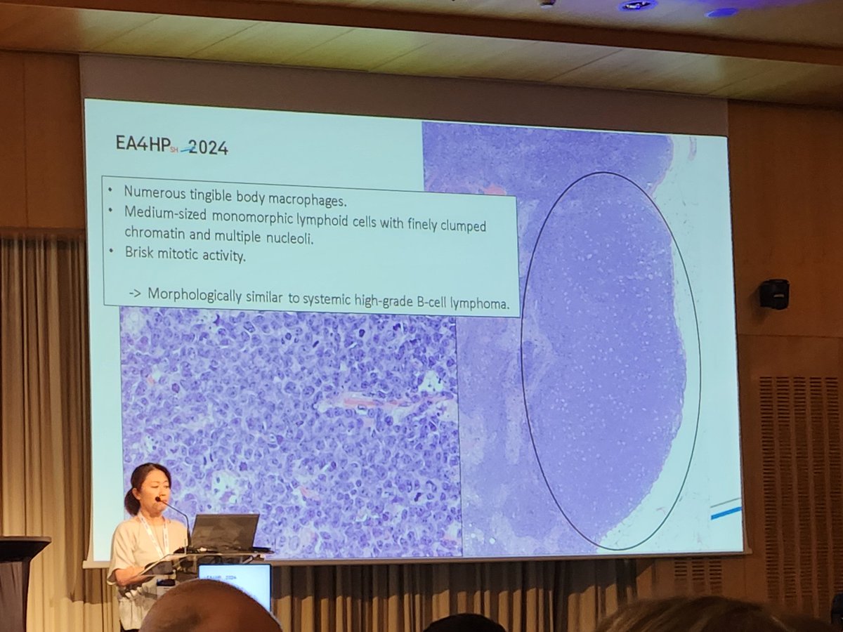 Mario Yabe presents the last oral case of the EA4HP 2024 lymphoma workshop, an incipient Burkitt lymphoma #hemepath