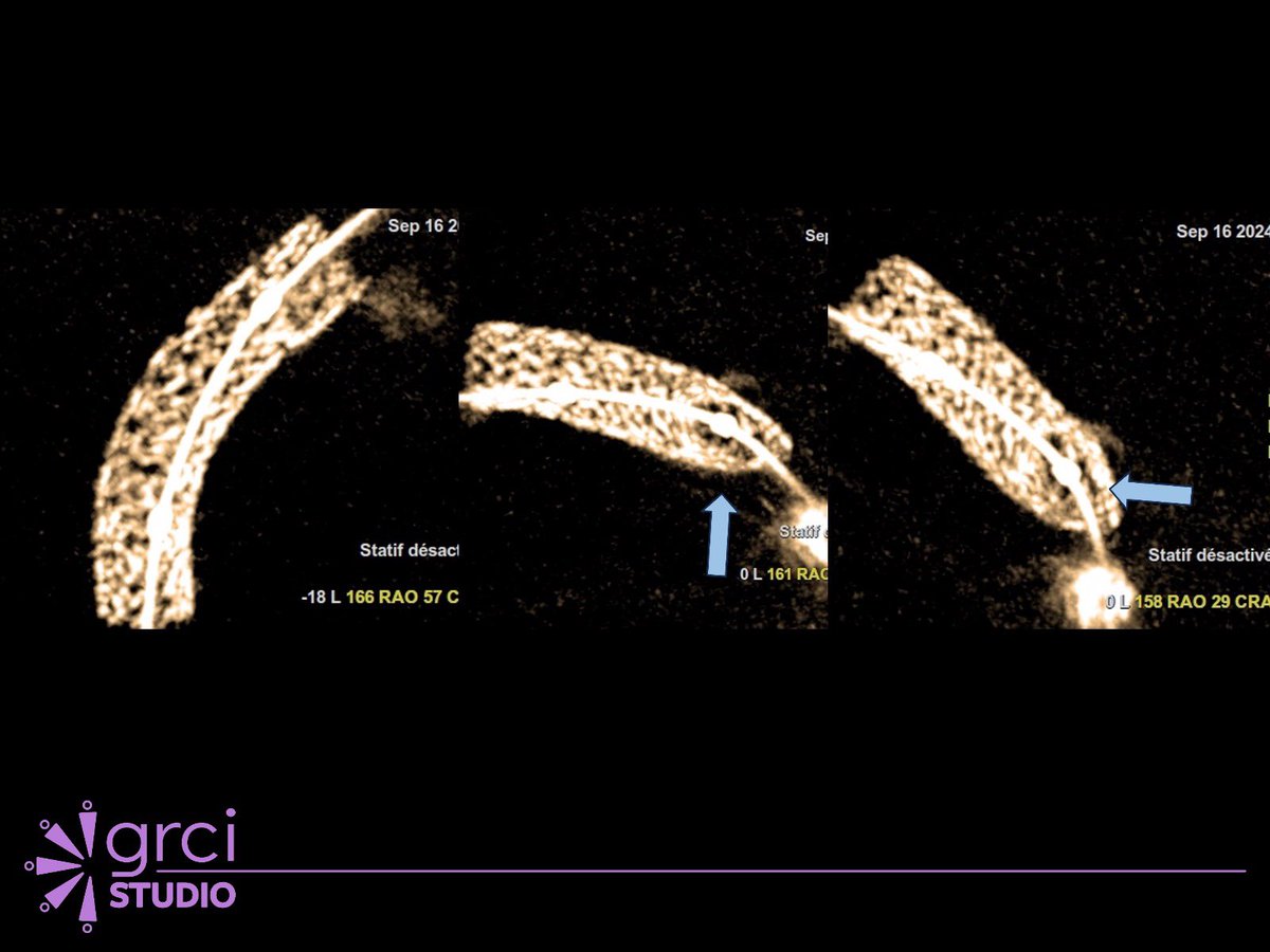 Institut Cardiovasculaire Paris Sud (ICPS) (@icps_institut) on Twitter photo 🔜 Ne manquez pas la session sur le réhaussement de stent avec le Dr <a href="/nicolasamabile/">Nicolas Amabile</a>, coordonnée par le Dr @HakimBenamer . Une présentation essentielle à découvrir pour enrichir vos connaissances en cardiologie interventionnelle.
📍 Studio
⏰ 13h40 - 14h00
#GRCI 🔜 Ne manquez pas la session sur le réhaussement de stent avec le Dr <a href="/nicolasamabile/">Nicolas Amabile</a>, coordonnée par le Dr @HakimBenamer . Une présentation essentielle à découvrir pour enrichir vos connaissances en cardiologie interventionnelle.
📍 Studio
⏰ 13h40 - 14h00
#GRCI
