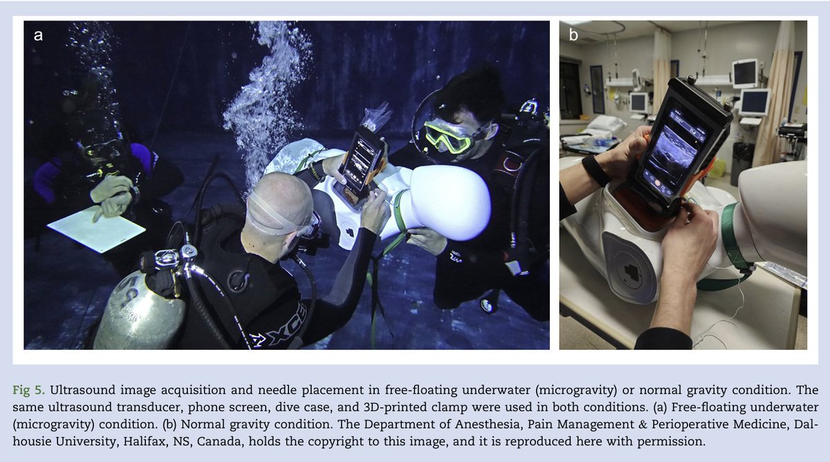 jon_bailey_anes's tweet image. The paper is officially out now! I've been excitedly waiting to share this one!
#microgravityโ
#spaceโ
#regionalanesthesiaโ
#scubaโ
Open access โ
Turns out that we are just as good at nerve blocks while floating as we are on solid ground
authors.elsevier.com/sd/article/S00โฆ