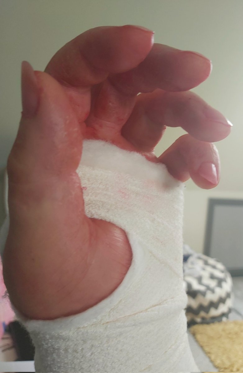 Midgetgems26's tweet image. I can now uncurl my fingers to this level. Like a weak Royal wave.
#ProgressReport