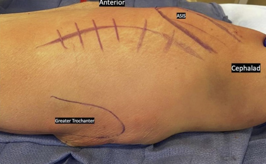 Arthroplasty Today (@arthrotoday) on Twitter photo This surgical technique paper from <a href="/UofUOrtho/">UofU Department of Orthopeadics</a> describes performing an intramedullary total femur replacement via a direct anterior approach for complex revision total hip and knee arthroplasty. <a href="/ElizabethAbe4/">Elizabeth Abe</a> <a href="/EdJDickenson/">Ed Dickenson</a> <a href="/MakarGabe/">Gabe Makar</a> <a href="/FreddyYangMD/">JaeWon (Freddy) Yang, MD</a>
arthroplastytoday.org/article/S2352-… This surgical technique paper from <a href="/UofUOrtho/">UofU Department of Orthopeadics</a> describes performing an intramedullary total femur replacement via a direct anterior approach for complex revision total hip and knee arthroplasty. <a href="/ElizabethAbe4/">Elizabeth Abe</a> <a href="/EdJDickenson/">Ed Dickenson</a> <a href="/MakarGabe/">Gabe Makar</a> <a href="/FreddyYangMD/">JaeWon (Freddy) Yang, MD</a>
arthroplastytoday.org/article/S2352-…