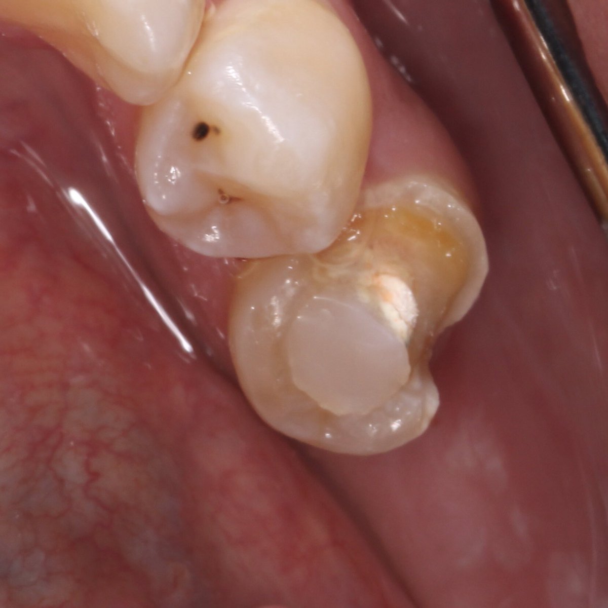 Case completion ✨

⁃Fiber post and core build up 

⁃Crown preparation

⁃Finally restoring the tooth with zirconia crown