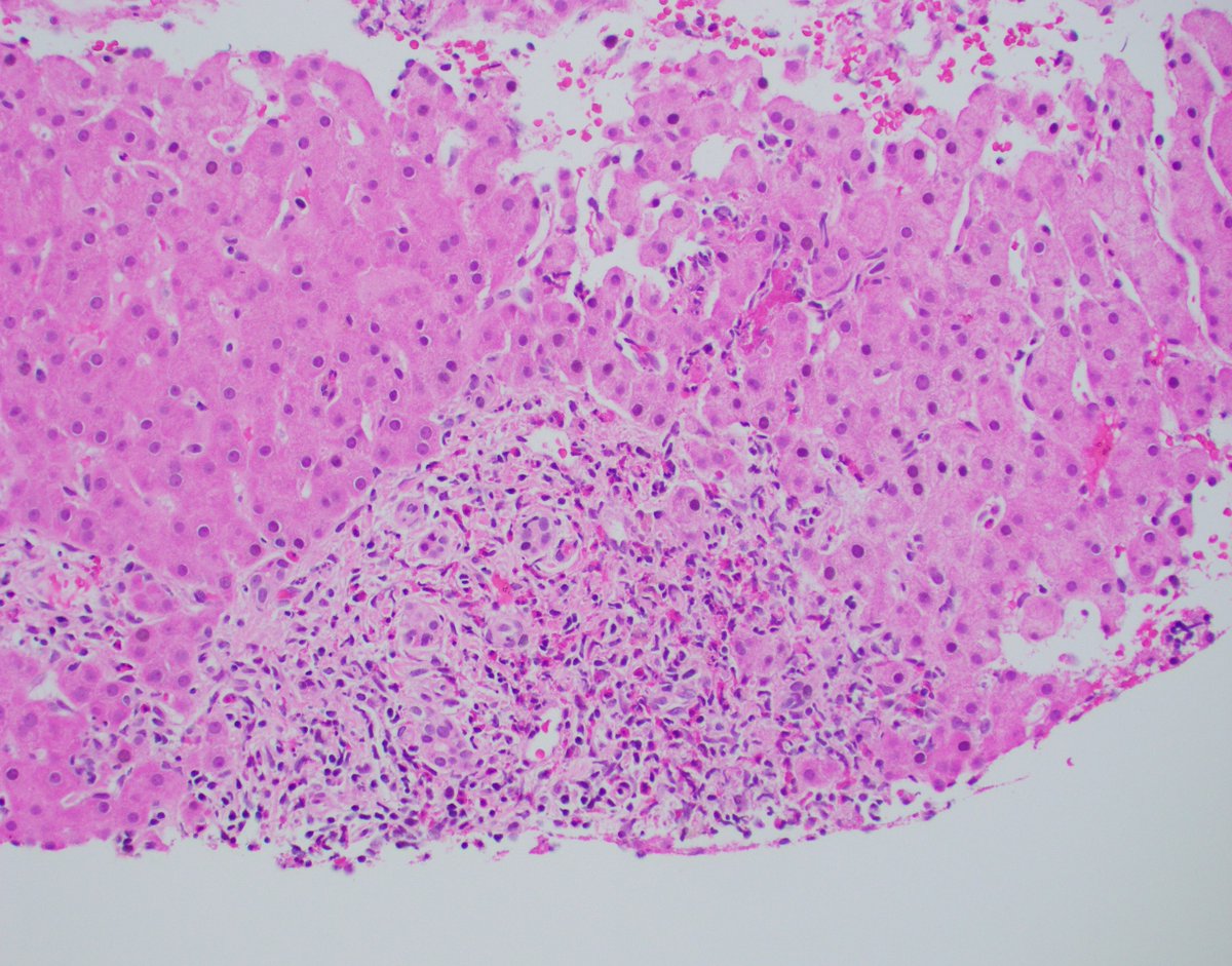 GIPathologyURMC's tweet photo. Eosinophilic cholangitis: rare but striking! 📸 Marked eosinophilic infiltration of bile ducts. A fascinating case for the books! #LiverPath #HepPath #GIPath #Histopathology #Pathology #PathBoards #PathResidents #PathTweetorial #pathx #pathtwitter #PathTweetAward #SurgPath https://t.co/yzLwlTy07S