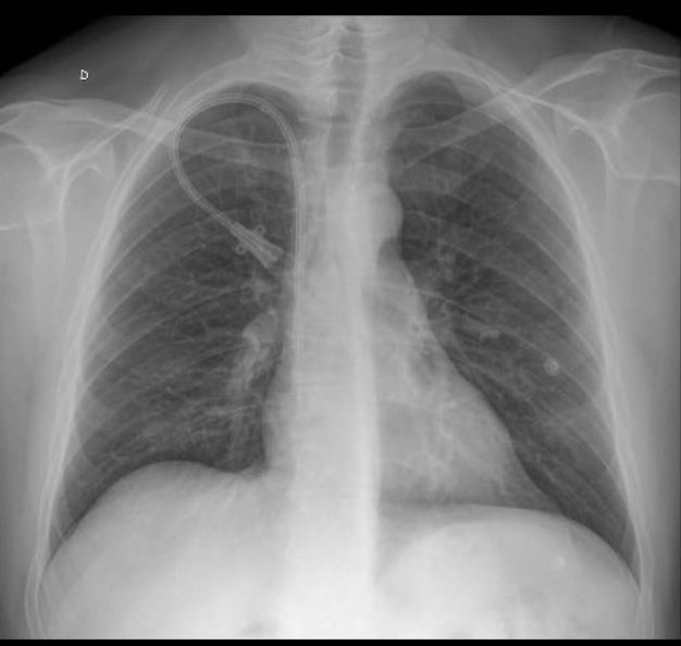 Catéter tunelizado yugular derecho
Colocación guiada por ultrasonido y referencias anatómicas, procedimientos echos por residentes HJM