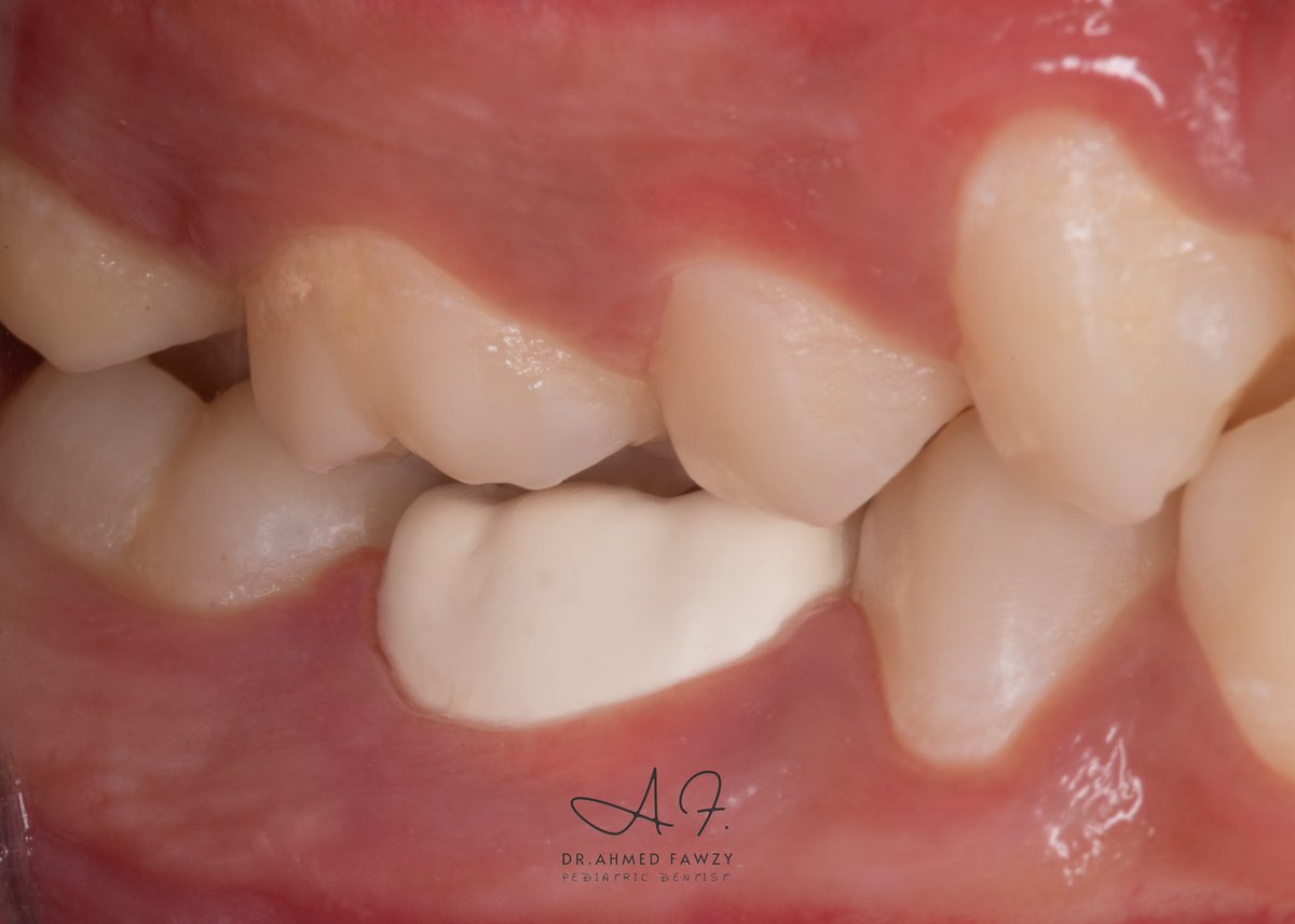 drfawzydentist's tweet photo. BioFlx Crown “Nusmile” for E size 7 covering an endodontically treated first permanent molar in a 14 year old teen…..

The “Dimple” for occlusal adaptation can be noted in the occlusal surface after 1 week. #Bioflx #nusmile https://t.co/7UBbJGBGGt