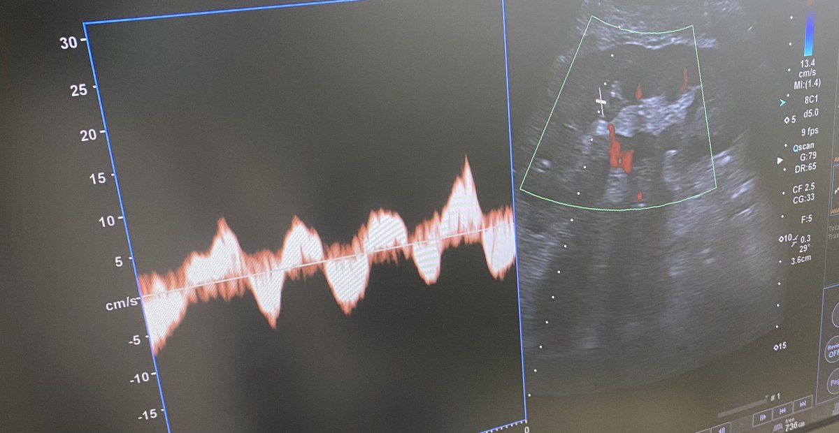 Grupo de Nefrología Diagnóstica e Intervencionista (@sengndi) on Twitter photo Utility of colour #Doppler #renal #ultrasound 24h post #kidney #transplantation what do you think? <a href="/SENefrologia/">S.E.N. Nefrología</a> <a href="/senjoven/">JovSEN</a> <a href="/ASDINNews/">ASDIN</a> <a href="/ynptweets/">YNP of ERA</a> @POCUS_Society #PoCUS Utility of colour #Doppler #renal #ultrasound 24h post #kidney #transplantation what do you think? <a href="/SENefrologia/">S.E.N. Nefrología</a> <a href="/senjoven/">JovSEN</a> <a href="/ASDINNews/">ASDIN</a> <a href="/ynptweets/">YNP of ERA</a> @POCUS_Society #PoCUS