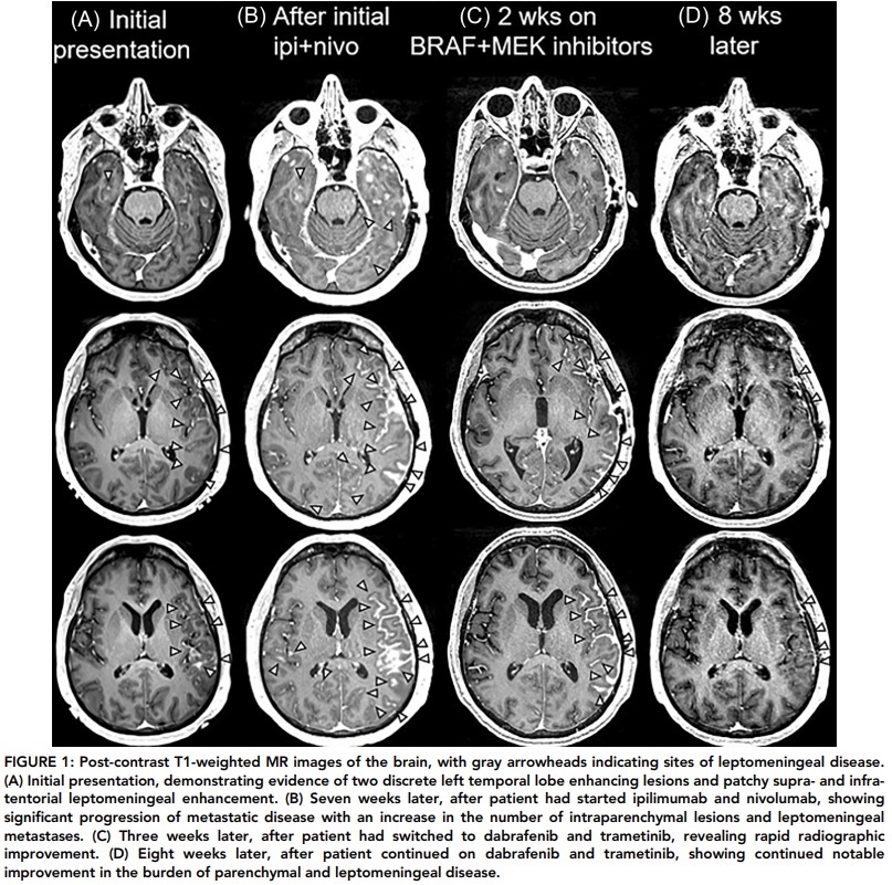 CPatel_Lab's tweet image. A case of BRAF V600-mutant melanoma with brain parenchymal and leptomeningeal metastases responsive to BRAF+MEK inhibition after initial immunotherapy. dx.doi.org/10.1002/ana.27… #Melanoma #metastasis #leptomeningeal_disease #LMD #brain_metastasis #BRAF #MEK #immunotherapy