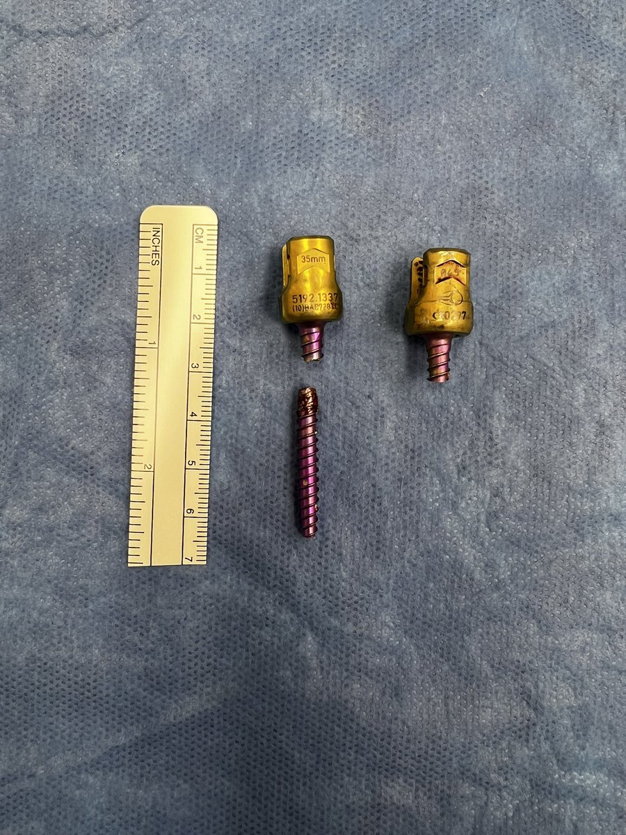W. Christopher Newman, MD (@spineoncdoc) on Twitter photo While we like to be minimally invasive and use short segment constructs at <a href="/MSKCCSpine/">MSKCC Spine Tumor Center</a>, it’s just as important to be able to revise the failures. Capturing the screw heads allows us to extend the construct in a minimally invasive fashion. #Neurosurgery #Oncology #Spine #Surgery While we like to be minimally invasive and use short segment constructs at <a href="/MSKCCSpine/">MSKCC Spine Tumor Center</a>, it’s just as important to be able to revise the failures. Capturing the screw heads allows us to extend the construct in a minimally invasive fashion. #Neurosurgery #Oncology #Spine #Surgery