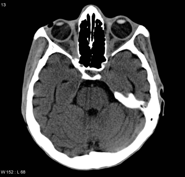 DocNavarrow's tweet image. Enoftalmos can be an unusual sign in patients with anorexia nervosa due to fat loss in the orbit, leading to sunken eyes. 

Case courtesy of Frank Gaillard, radiopaedia.org/cases/5307?lan…