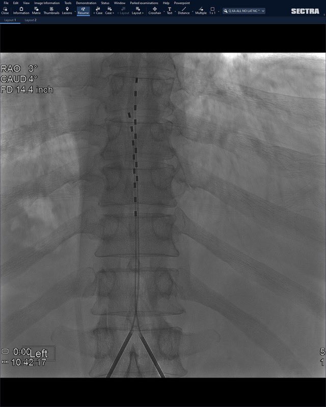 <a href="/JunManKimMD/">Junman Kim MD</a> places first set of #irad @Nevro_HFX spinal cord stimulator trial leads at <a href="/EmoryMedicine/">Emory School of Medicine</a> <a href="/emoryhealthcare/">Emory Healthcare</a> @EmoryRadiology 🔥🔥🔥 <a href="/SIRspecialists/">Society of Interventional Radiology</a> <a href="/dougbeall/">Douglas Beall</a> <a href="/ImagingDoctor/">Dana Dunleavy, MD</a> <a href="/alexalevey/">Alexa Levey, MD</a> <a href="/junjian_huang/">Junjian Huang</a> <a href="/roblookstein/">Robert A Lookstein MD, MHCDL</a>