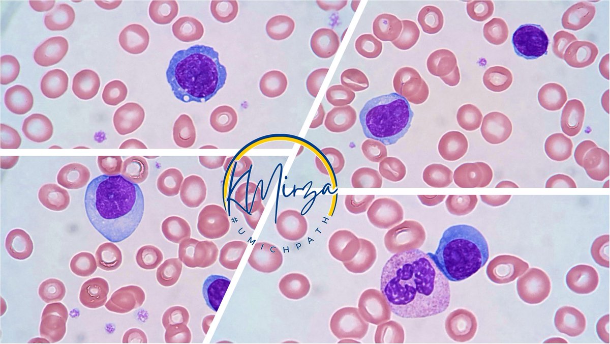A few years ago, I got temporarily stumped by the morphology of these circulating leukocytes...

Any guesses what these cells are? What's the diagnosis? #hemepath #hematology @umichtpath #UMichPath