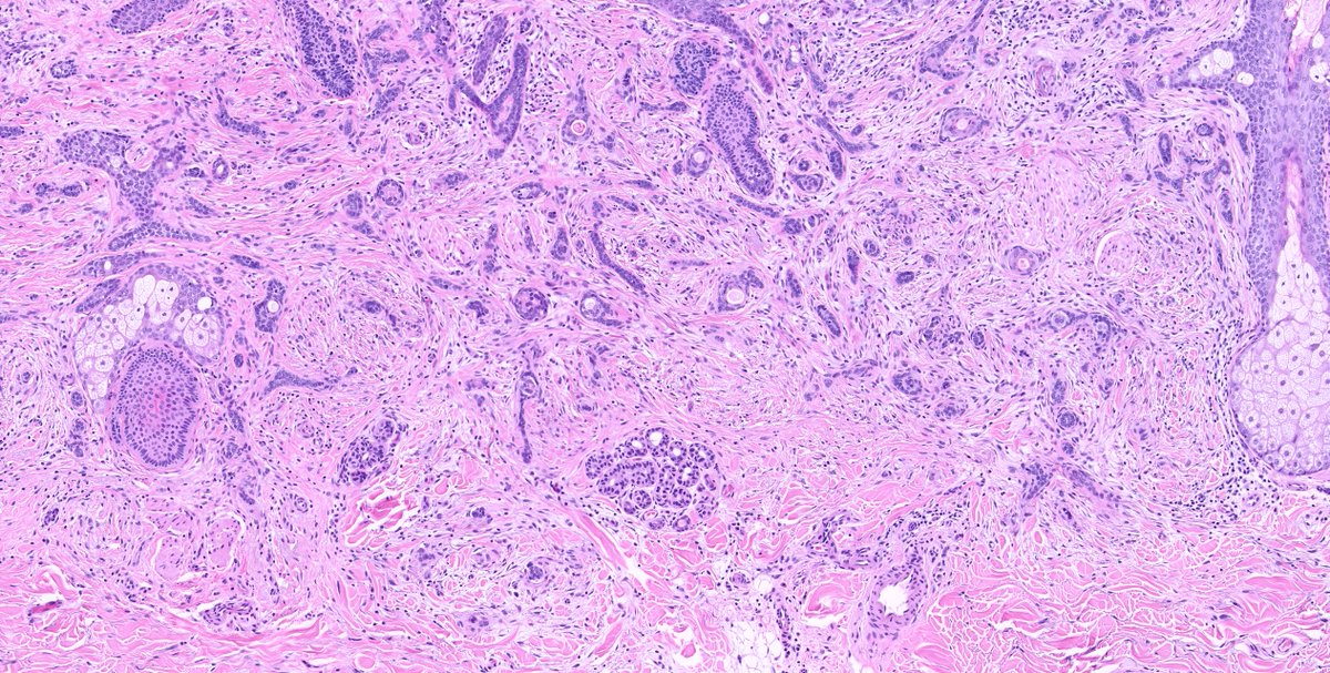 kis_lorand's tweet photo. 1/ Another skin tumor where I wonder if the IHCs are of any use in the ddx 👇👇
#pathology #dermpath
@JacobSmalberger
@RACARR51 https://t.co/a4sZ3CL1Yx