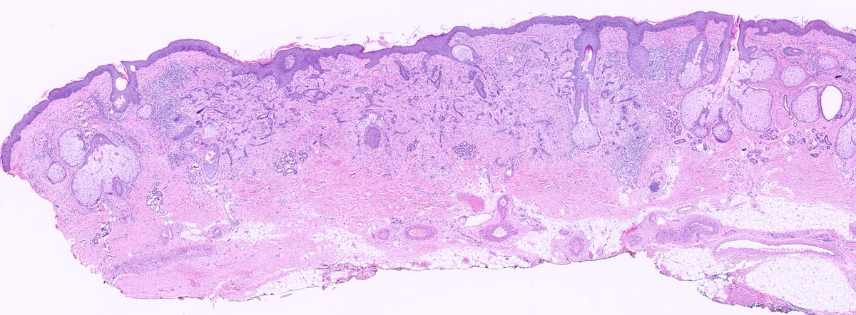 kis_lorand's tweet photo. 1/ Another skin tumor where I wonder if the IHCs are of any use in the ddx 👇👇
#pathology #dermpath
@JacobSmalberger
@RACARR51 https://t.co/a4sZ3CL1Yx