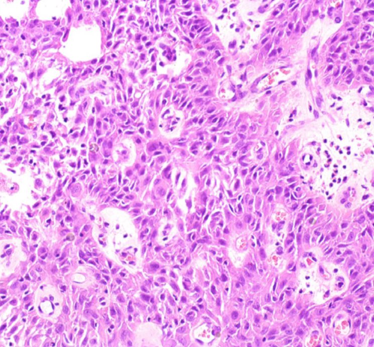PenafortPaulo's tweet photo. We find that DNA content associated with clinicopathological features helps distinguish ameloblastoma from ameloblastic carcinoma. Our findings are published in the Journal of Oral Pathology &amp; Medicine.https://t.co/0sWnnM0YVB https://t.co/BbvAqFrM3j
