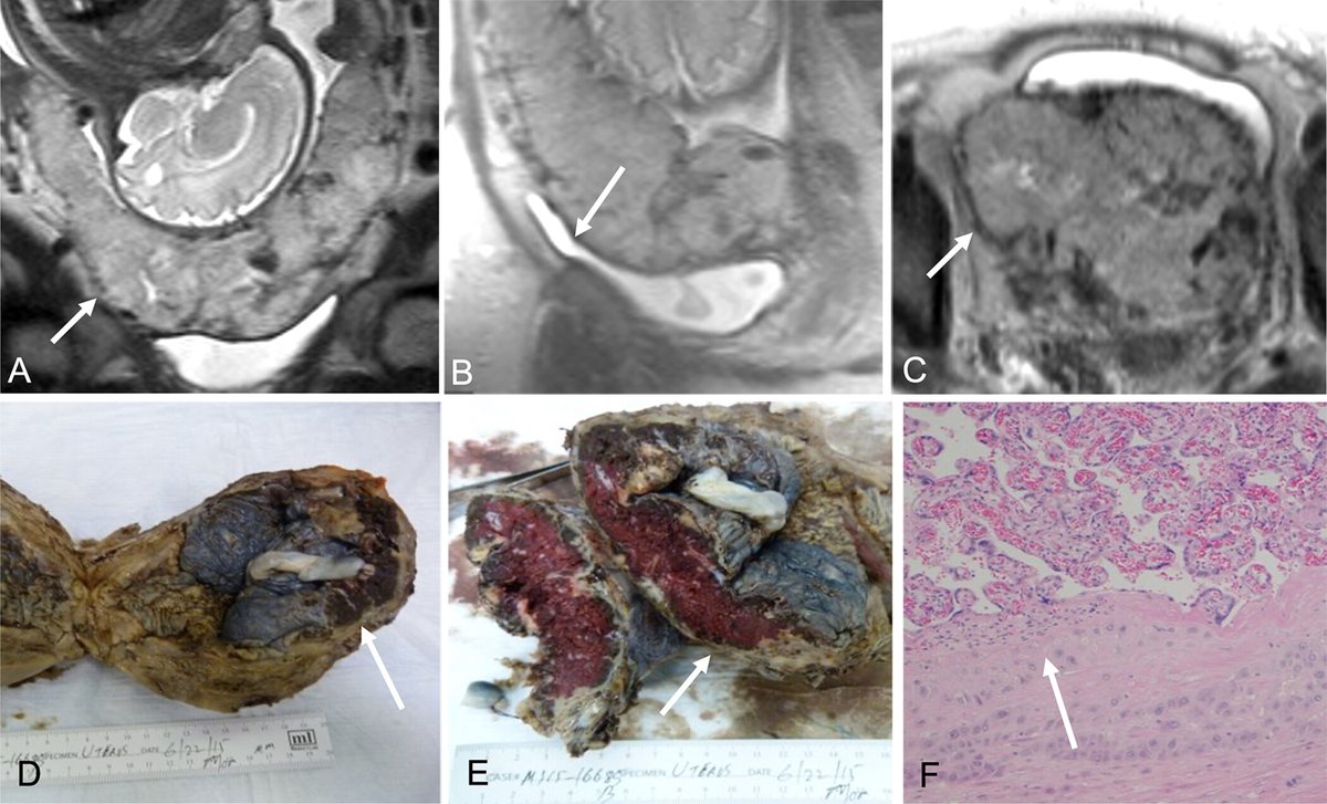 Radiology (@radiology_rsna) on Twitter photo MRI findings of placenta accreta spectrum have limited reproducibility. Additional training, education, clarification on feature definitions, and consideration for double-reading may be needed. <a href="/mswradiology/">Mount Sinai West Radiology</a> <a href="/MountSinaiDMIR/">Mount Sinai Diag, Molecular, and Interv Radiology</a> <a href="/DrAmitaKamath/">Amita Kamath</a> bit.ly/4ettjVo MRI findings of placenta accreta spectrum have limited reproducibility. Additional training, education, clarification on feature definitions, and consideration for double-reading may be needed. <a href="/mswradiology/">Mount Sinai West Radiology</a> <a href="/MountSinaiDMIR/">Mount Sinai Diag, Molecular, and Interv Radiology</a> <a href="/DrAmitaKamath/">Amita Kamath</a> bit.ly/4ettjVo