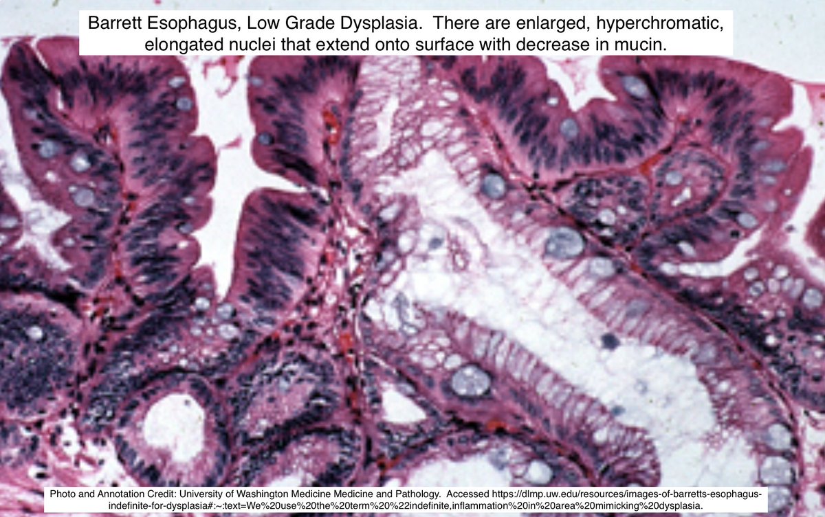 Path4People's tweet photo. #pathtip Esophageal Dysplasia in Barrett

1️⃣ Surface Maturation (eg. glands and surface have similar nuclear size)
2️⃣ Gland Architecture (eg. crowding, cribriform, cystic dilation, necrotic luminal debris)
3️⃣ Cytology (eg. Hyperchromatic, polarity)
4️⃣ 👀 for inflammation+erosions https://t.co/ZTdcAygaW2