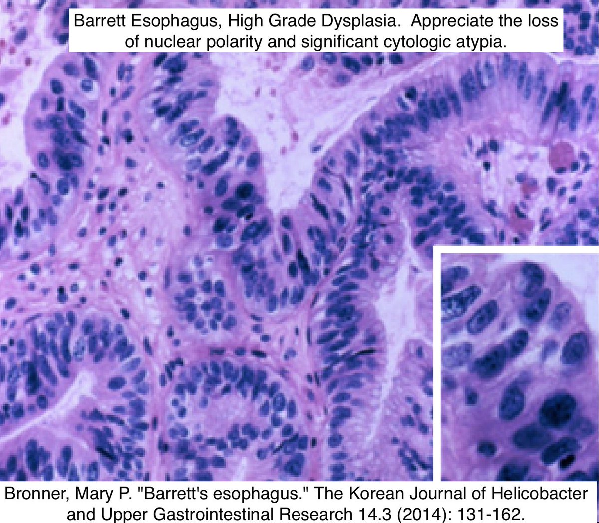 Path4People's tweet photo. #pathtip Esophageal Dysplasia in Barrett

1️⃣ Surface Maturation (eg. glands and surface have similar nuclear size)
2️⃣ Gland Architecture (eg. crowding, cribriform, cystic dilation, necrotic luminal debris)
3️⃣ Cytology (eg. Hyperchromatic, polarity)
4️⃣ 👀 for inflammation+erosions https://t.co/ZTdcAygaW2