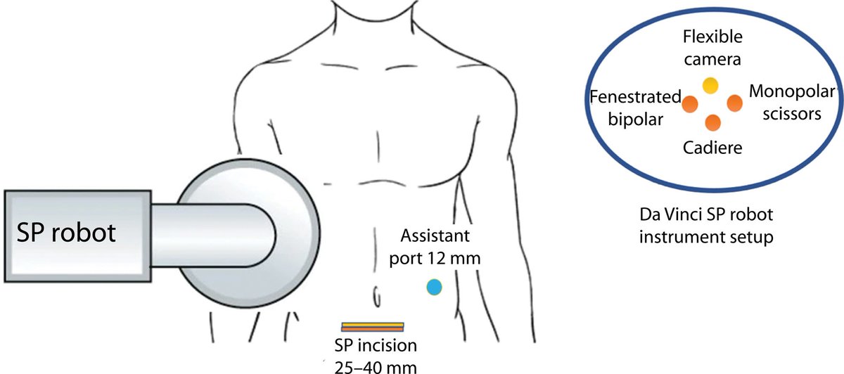 DCRjournal (@dcrjournal) on Twitter photo #DCRJournal New Technology Report - Initial Experience with Single Port Robotic Right Colectomies by @ankitsarinmd <a href="/UCDavisSurgery/">UC Davis Surgery</a> <a href="/UCSFSurgery/">UCSF Surgery</a> <a href="/UCSFSkillsLab/">UCSF Surgical Skills Center</a> <a href="/feromeroher/">Fernanda Romero-Hernandez</a> <a href="/dbhoffman/">Daniel Hoffman MD</a> - bit.ly/3MFvlWo
<a href="/patsyllamd/">Patricia Sylla</a> #DCRJournal New Technology Report - Initial Experience with Single Port Robotic Right Colectomies by @ankitsarinmd <a href="/UCDavisSurgery/">UC Davis Surgery</a> <a href="/UCSFSurgery/">UCSF Surgery</a> <a href="/UCSFSkillsLab/">UCSF Surgical Skills Center</a> <a href="/feromeroher/">Fernanda Romero-Hernandez</a> <a href="/dbhoffman/">Daniel Hoffman MD</a> - bit.ly/3MFvlWo
<a href="/patsyllamd/">Patricia Sylla</a>