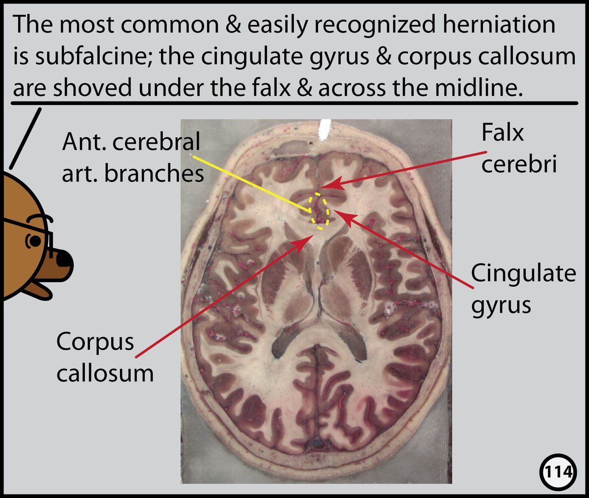 This week, I’ll post excerpts from our Head CT comic. The complete comic is available for free here: radiopaedia.org/courses/head-c…