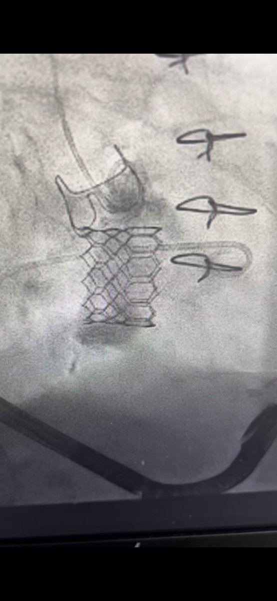 Pedro Villablanca MD, MSc, FACC, FSCAI (@pedromdmsc) on Twitter photo Another valve in MAC area 910 29mm plus 7cc with IVL facilitated BATMAN. <a href="/g_giustinoMD/">Gennaro Giustino, MD</a> was visiting so we couldn’t do less ! <a href="/MohammedQintar/">Mohammed Qintar, MD MSc</a> <a href="/claulamavb/">Claudia Lama von Buchwald, MD</a> <a href="/GusonKang/">Guson Kang</a> <a href="/kentso987/">Kent, So</a> <a href="/MichaelChiangCS/">Michael Chiang MBBS,FHKCP,FHKAM,FESC,FSCAI,FACC</a> <a href="/fangjonathanx/">Jonathan X Fang, MBBS, FACC, FSCAI</a> <a href="/engelpedro/">Pedro Engel, MD, FACC, FSCAI</a> Another valve in MAC area 910 29mm plus 7cc with IVL facilitated BATMAN. <a href="/g_giustinoMD/">Gennaro Giustino, MD</a> was visiting so we couldn’t do less ! <a href="/MohammedQintar/">Mohammed Qintar, MD MSc</a> <a href="/claulamavb/">Claudia Lama von Buchwald, MD</a> <a href="/GusonKang/">Guson Kang</a> <a href="/kentso987/">Kent, So</a> <a href="/MichaelChiangCS/">Michael Chiang MBBS,FHKCP,FHKAM,FESC,FSCAI,FACC</a> <a href="/fangjonathanx/">Jonathan X Fang, MBBS, FACC, FSCAI</a> <a href="/engelpedro/">Pedro Engel, MD, FACC, FSCAI</a>
