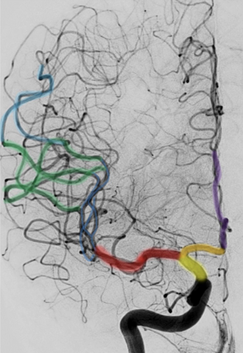 Thanh Nguyen 🇺🇦 (@nguyenthanhmd) on Twitter photo Endovascular management of acute stroke sciencedirect.com/science/articl… <a href="/TheLancet/">The Lancet</a>
<a href="/AbdalkaderMD/">Mohamad AbdalKader</a> <a href="/FishingNeurons/">Urs Martin Fischer</a> <a href="/NagelSimon/">Simon Nagel</a> <a href="/ZhongrongMiao/">Zhongrong Miao</a> <a href="/PoojaKhatriMD/">Pooja Khatri</a> Endovascular management of acute stroke sciencedirect.com/science/articl… <a href="/TheLancet/">The Lancet</a>
<a href="/AbdalkaderMD/">Mohamad AbdalKader</a> <a href="/FishingNeurons/">Urs Martin Fischer</a> <a href="/NagelSimon/">Simon Nagel</a> <a href="/ZhongrongMiao/">Zhongrong Miao</a> <a href="/PoojaKhatriMD/">Pooja Khatri</a>