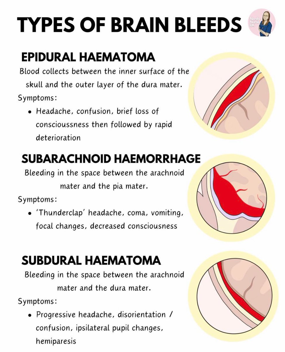 Doctors__squad's tweet photo. Types of BRAIN BLEEDS 🩸 https://t.co/tIeGZ05c1Z