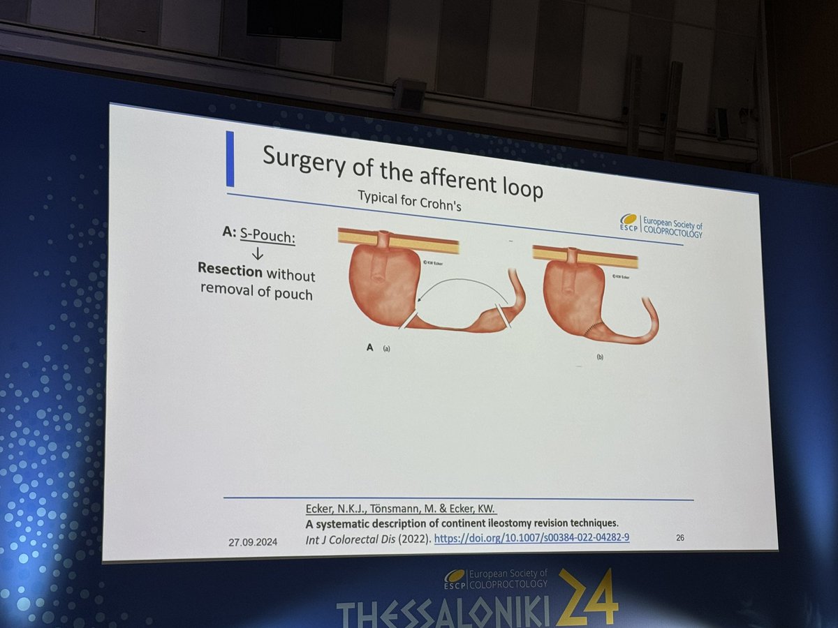 SWexner's tweet photo. @GabrielaMoslein @escp_tweets shares her considerable expertise with continent ileostomy/ Kock pouch #ESCP24 https://t.co/gDw7Uka3ud
