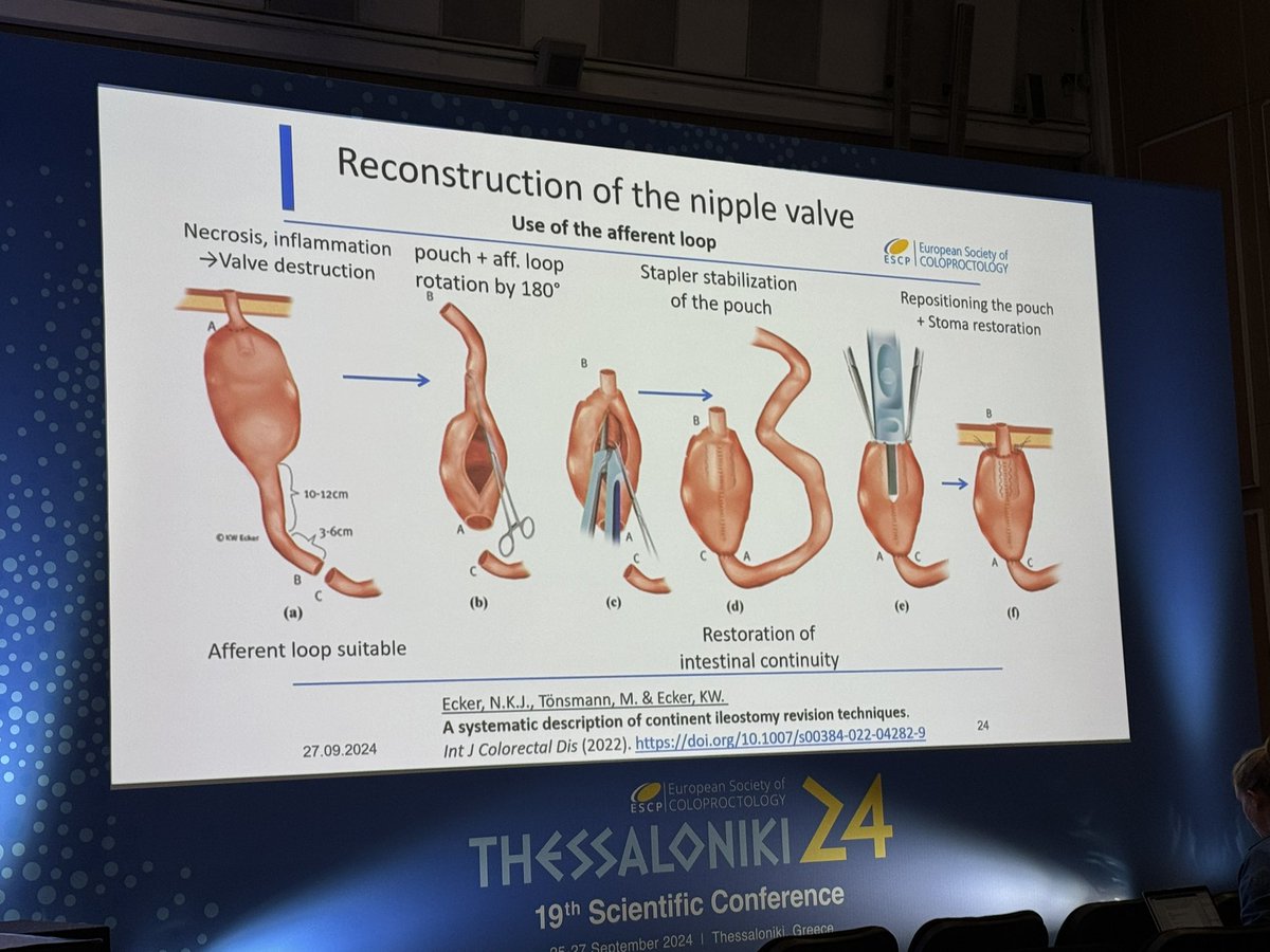 SWexner's tweet photo. @GabrielaMoslein @escp_tweets shares her considerable expertise with continent ileostomy/ Kock pouch #ESCP24 https://t.co/gDw7Uka3ud