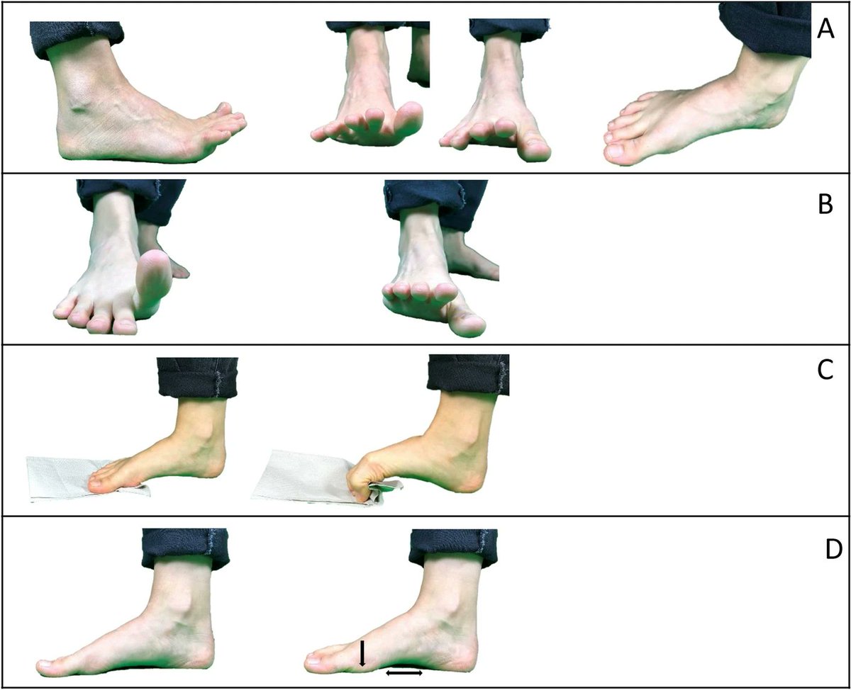 Local and non-local effects (on the posterior chain) of four weeks of foot exercises: a randomized controlled trial 🦶

pubmed.ncbi.nlm.nih.gov/39317709/

"Foot posture (index) improved by 26% in the trained leg &amp; by 11% in the untrained leg from baseline to the end of the intervention."