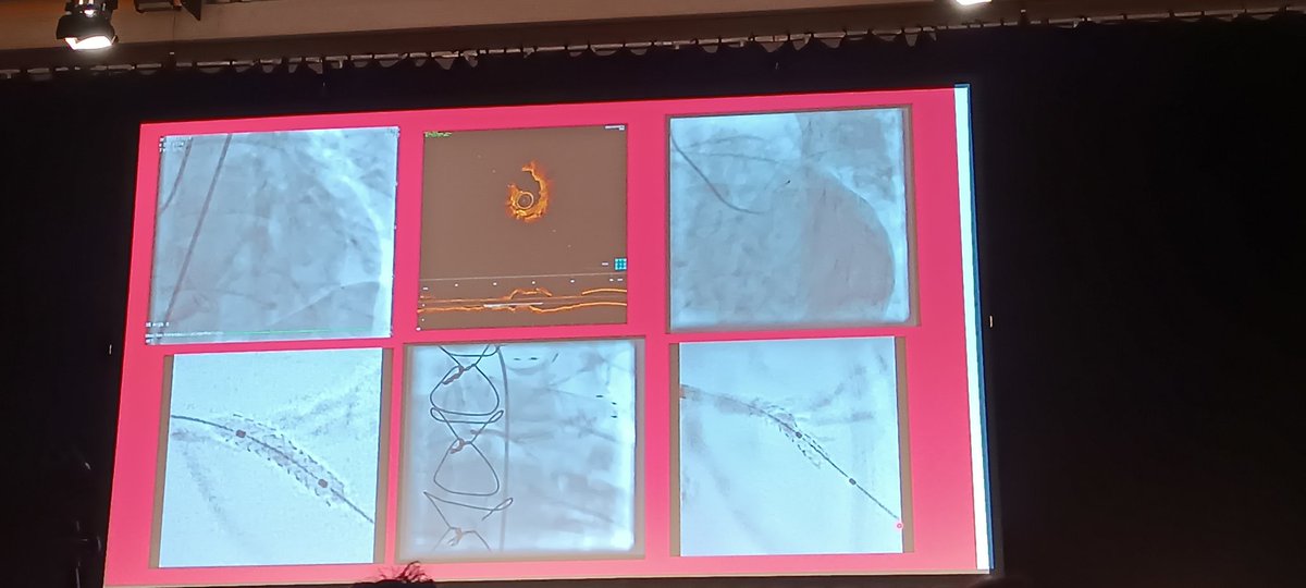 Michael Klinkhammer (@klinki_hh) on Twitter photo Im letzten Vortrag der Session stellt Christoph Liebetrau seinen Fall zur Sternthrombose vor.
#DGKHerztage <a href="/DGK_org/">Deutsche Gesellschaft für Kardiologie</a> <a href="/AGIKinterv/">AGIK</a> <a href="/HolgerNef/">Holger Nef</a> @MoritzSeiffert <a href="/dscharpfMD/">Dominik Scharpf</a> <a href="/thiele_holger/">Holger Thiele</a> <a href="/kaschenke/">Karsten Schenke 📯 @kaschenke.blsky.social</a> <a href="/VRubesch/">Vanessa Rubesch</a> <a href="/DrCathaHamm/">Catharina Hamm MD</a> Im letzten Vortrag der Session stellt Christoph Liebetrau seinen Fall zur Sternthrombose vor.
#DGKHerztage <a href="/DGK_org/">Deutsche Gesellschaft für Kardiologie</a> <a href="/AGIKinterv/">AGIK</a> <a href="/HolgerNef/">Holger Nef</a> @MoritzSeiffert <a href="/dscharpfMD/">Dominik Scharpf</a> <a href="/thiele_holger/">Holger Thiele</a> <a href="/kaschenke/">Karsten Schenke 📯 @kaschenke.blsky.social</a> <a href="/VRubesch/">Vanessa Rubesch</a> <a href="/DrCathaHamm/">Catharina Hamm MD</a>