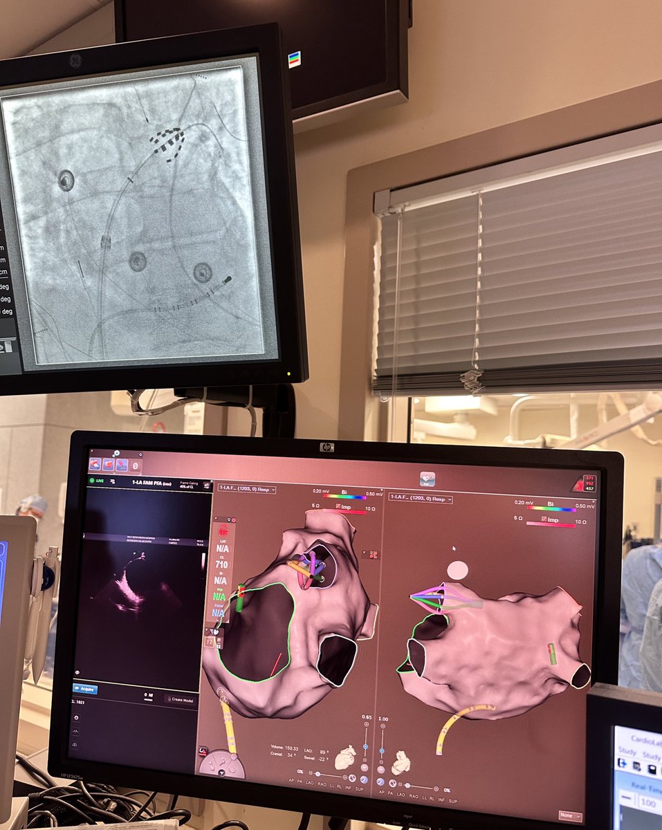 A. John Kadado MD (@ajkadado) on Twitter photo First Carto Sound integrated PFA case with Dr. Grubman in the books! <a href="/YaleCardiology/">Yale Cardiology</a> <a href="/SethFakess/">Seth Fakess</a> <a href="/jfreeMD/">James V. Freeman</a> <a href="/Teebi_MD/">Ahmed Teebi, MD MPH🗝️</a> <a href="/rraven8/">Ricardo Avendaño, MD</a> #EPeeps First Carto Sound integrated PFA case with Dr. Grubman in the books! <a href="/YaleCardiology/">Yale Cardiology</a> <a href="/SethFakess/">Seth Fakess</a> <a href="/jfreeMD/">James V. Freeman</a> <a href="/Teebi_MD/">Ahmed Teebi, MD MPH🗝️</a> <a href="/rraven8/">Ricardo Avendaño, MD</a> #EPeeps