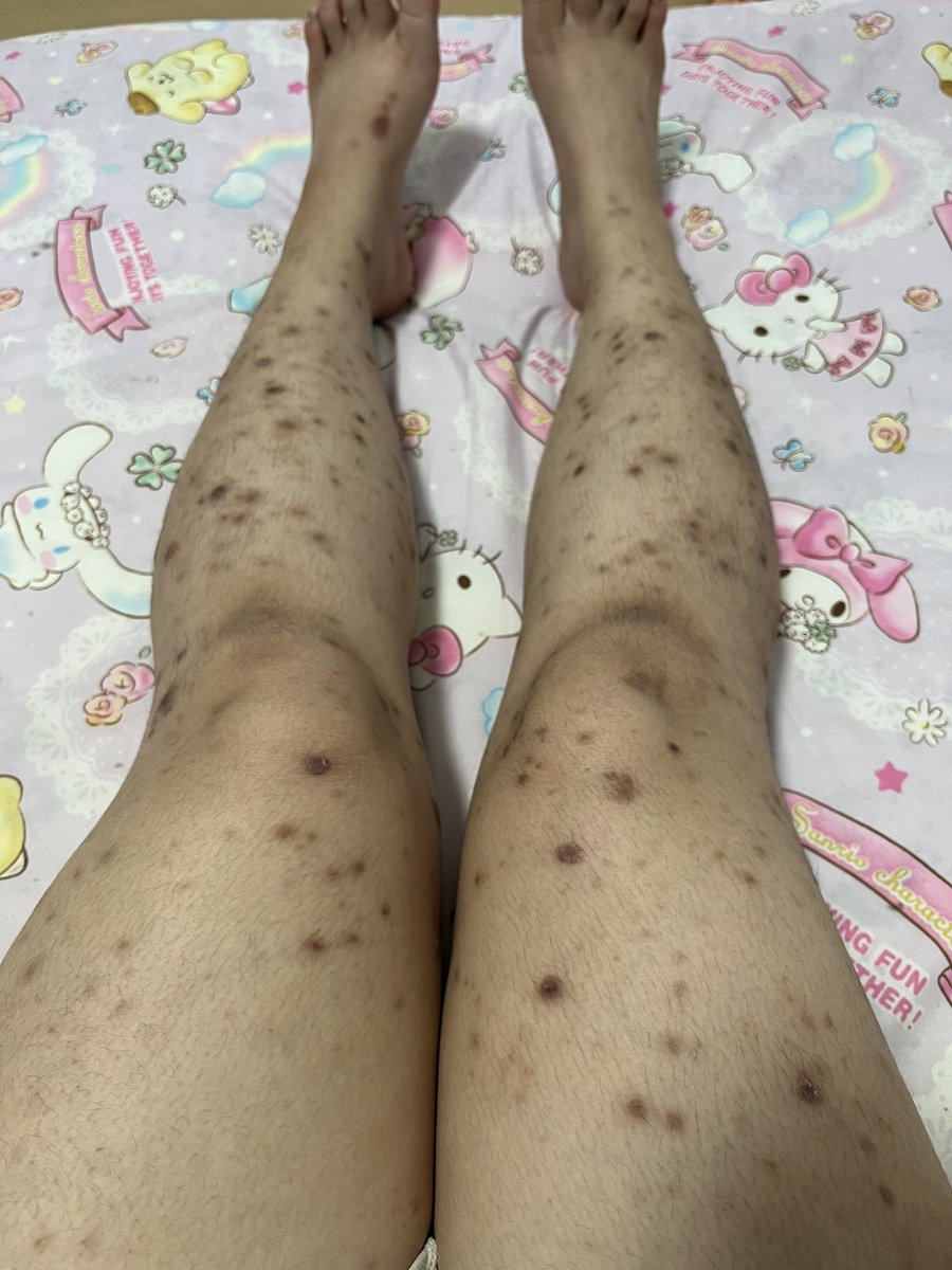 ruti_among's tweet photo. 痒みはかなり収まり、足の傷はほとんどなくなりカサブタもとれた。
お風呂入っても染みないの最高…
ずっとムダ毛の処理も出来なかったけど、そろそろしてもいいかも〜 https://t.co/CE5ZCRPoGg