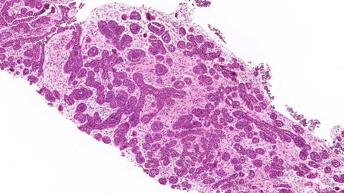 Fibroepithelial Friday 🔬

What is the diagnosis of this fibroepithelial lesion of the breast?

Poll in the comments 👇

Answer to be posted on Monday

#PathTwitter #PathX #breastpath