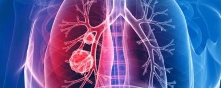 Un análisis de sangre predice el riesgo de desarrollar epoc

omniprex.com/un-analisis-de…