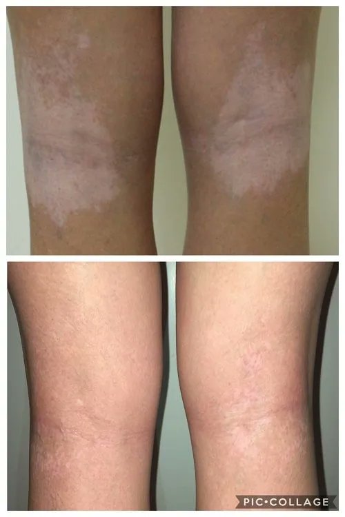 Vitiligoprotocl's tweet image. These - and many other before and after vitiligo #repigmentation photos sent to me by #vitiligo friends around the world who have used #nutritional #supplementation for their skin - can be found at thevitpro.com/reviews-and-te…