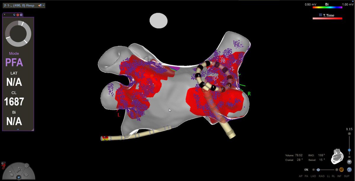 GustavoRRodrigues (@life_activist_) on Twitter photo Varipulse early in the morning ‘keeps de doctor away’!! <a href="/cgmarinescu/">Cătălin Marinescu</a> <a href="/jjmt_ep/">Johnson & Johnson MedTech | Electrophysiology</a>
HospitalSantaCruz, Carnaxide Varipulse early in the morning ‘keeps de doctor away’!! <a href="/cgmarinescu/">Cătălin Marinescu</a> <a href="/jjmt_ep/">Johnson & Johnson MedTech | Electrophysiology</a>
HospitalSantaCruz, Carnaxide