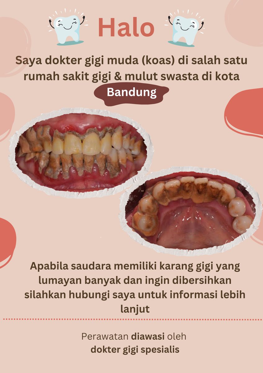 ujioci's tweet photo. sampurasun warga kota bandung! bagi yang pengen bersihin karang gigi (scaling) boleh banget dm ya🤗 

gratis!!

#koasgigibandung #koasgigi https://t.co/ndRXUIvTUi