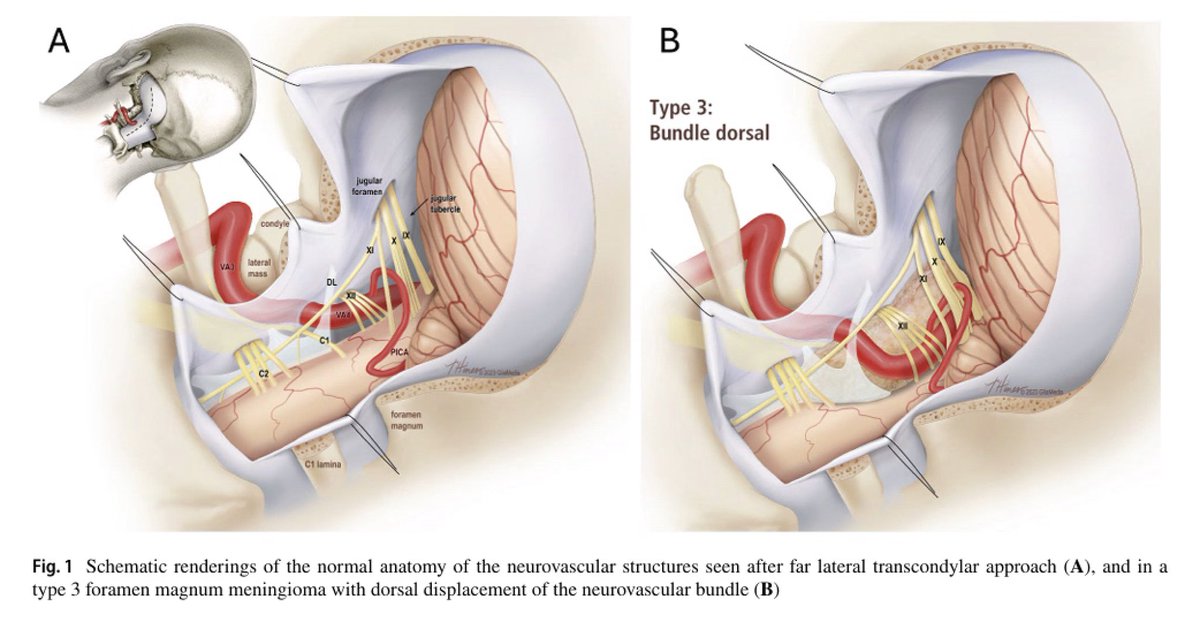 #OnlineFirst: How I do it: safe resection of a complex type 3 foramen magnum meningioma with dorsal displacement of the neurovascular bundle

Check out the Acta Neurochirurgica Article at: link.springer.com/article/10.100…

#neurosurgery #actaneuro #meningioma