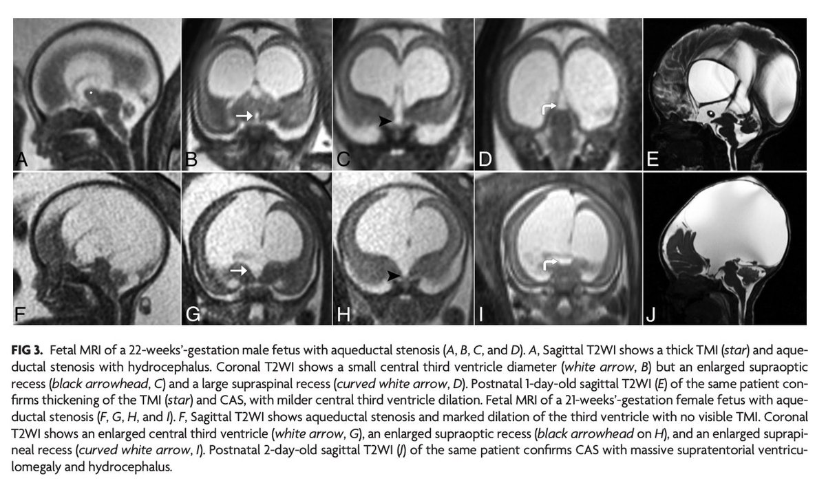 AJNR (@theajnr) on Twitter photo "Third Ventricle Diameter Is Inversely Related to Thalamic Massa Intermedia Thickness in Hydrocephalus Caused by Congenital Aqueductal Stenosis"
doi.org/10.3174/ajnr.A…
<a href="/onursimsekMD/">Onur Şimşek</a>; <a href="/armanten/">Amirreza Manteghinejad</a>; <a href="/MTWhiteheadMD/">Matthew T. Whitehead</a>; @Chopradiology; <a href="/The_ASPNR/">American Society of Pediatric Neuroradiology</a> "Third Ventricle Diameter Is Inversely Related to Thalamic Massa Intermedia Thickness in Hydrocephalus Caused by Congenital Aqueductal Stenosis"
doi.org/10.3174/ajnr.A…
<a href="/onursimsekMD/">Onur Şimşek</a>; <a href="/armanten/">Amirreza Manteghinejad</a>; <a href="/MTWhiteheadMD/">Matthew T. Whitehead</a>; @Chopradiology; <a href="/The_ASPNR/">American Society of Pediatric Neuroradiology</a>