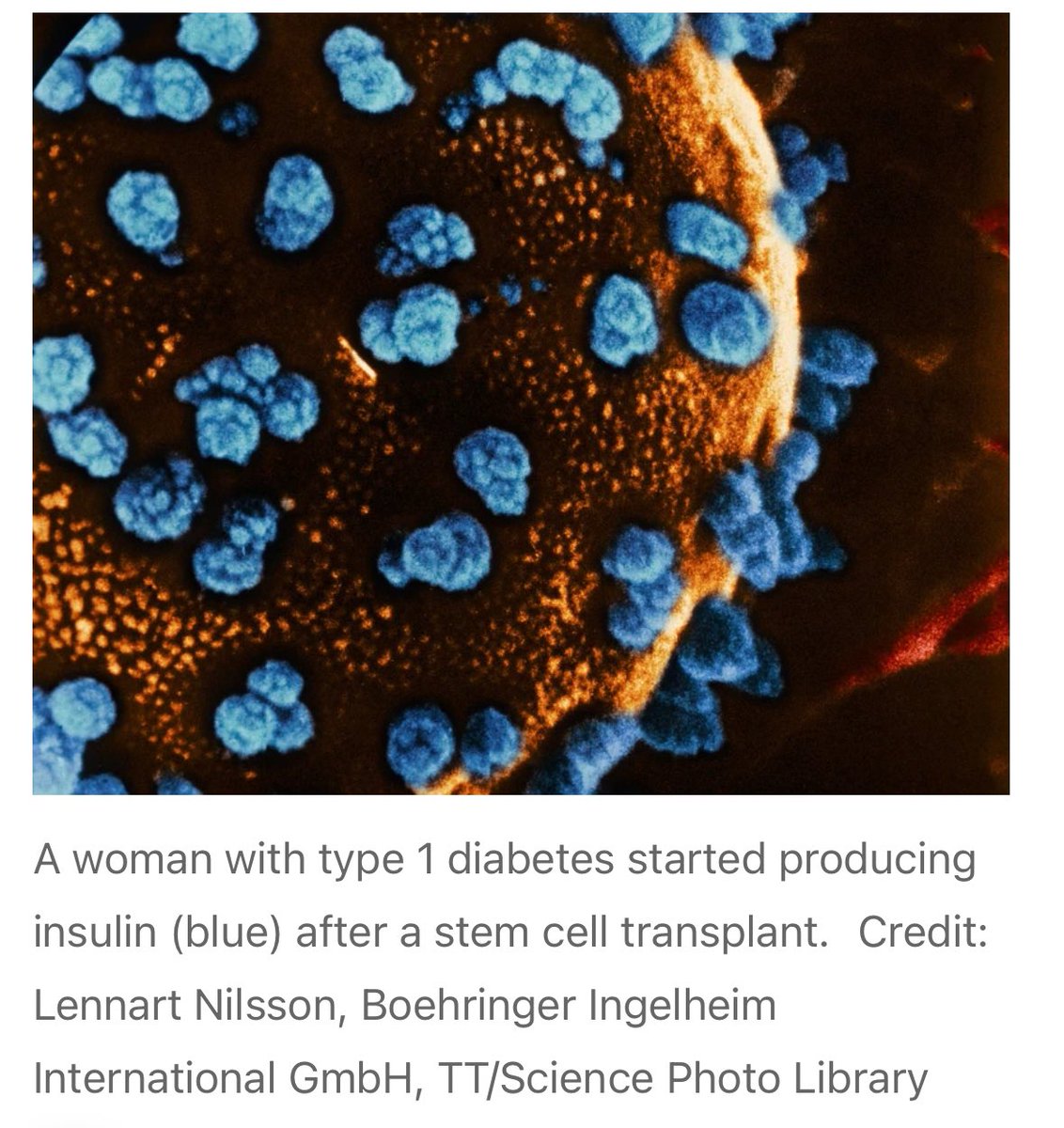 Günün en güzel haberi:

Dünyada ilk defa Tip 1 diyabetli bir hasta, kök hücre nakliyle tamamen iyileşti.
25 yaşındaki kadın, yeniden programlanmış kök hücre naklinden sadece 2,5 ay sonra kendi insülinini üretmeye başladı. Artık insülin kullanmıyor.

Dünyada bir ilk 👏