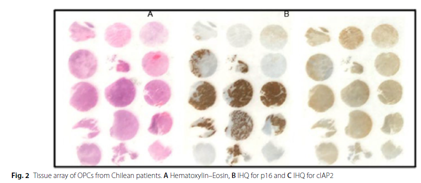 Juliogen's tweet image. cIAP2 protein in oropharyngeal cancer. Our study suggests targeting cIAP2 might improve treatment outcomes for HPV-positive head and neck cancers. #HPV #headandneckcancer #radiationtherapy #clinicalresearch
researchgate.net/publication/38…