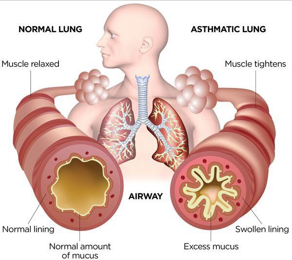 amerix's tweet photo. About Asthma:

Asthma is acquired. It is not inherited.

There may be very rare cases of inheritance due to the mutation of specific genes responsible for bronchiole stimulation, but asthma is acquired.

When it is acquired

- It can be outlived. 

- It can go to adulthood.

In fact, in children, there is a condition which is a precursor to asthma known as Larynchotracheobronchitis (LTB) that ends when the baby is 3 years old. But if it persists, it complicates asthma.

Asthma is autoimmune.

The specific type of white blood cells fails to recognize the stimuli in the respiratory tree, leading to a fierce battle in the bronchioles and, therefore, chronic inflammation.

Asthma is a symptom of the failure of the adrenal glands to tone down this inflammation, and that is why patients with asthma are prescribed steroids like corticosteroids

Steroids like cortisol are released from the adrenal glands to tone down inflammation and remind the white blood cells that the cells about to be eaten are not foreign. 

Babies can acquire asthma:

- If they were born by caesarean section

- If they were born and live in super clean environments 

- If they live in environments where there is no soil, dirt, pollen, or animals

- If they were exposed to antibiotics and artificial milk like NAN

- If they are not exposed to sunshine

It is for this reason that children born in informal settlements or on rural farms are less likely to develop asthma.

Asthma is curable.

The pharmaceutical industry cheats you that it is lifelong. 

It is NOT.

The industry walks around with such lies to hook you on inhalers and other drugs.

The human body was not designed to live on drugs forever.

If you simply:

• Fix your diet

• Consume the sun

• Expose your body to physical exercise

—  asthma will begin subsiding.

Stop being a slave of the system.

#FoodFriday