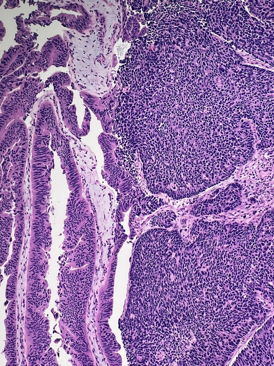 Gallbladder, cholecystectomy:_______

No prior history of cancer. 

How would you sign this out?
Which stains would you order?

#GIpath #PathX #COTW #2for1