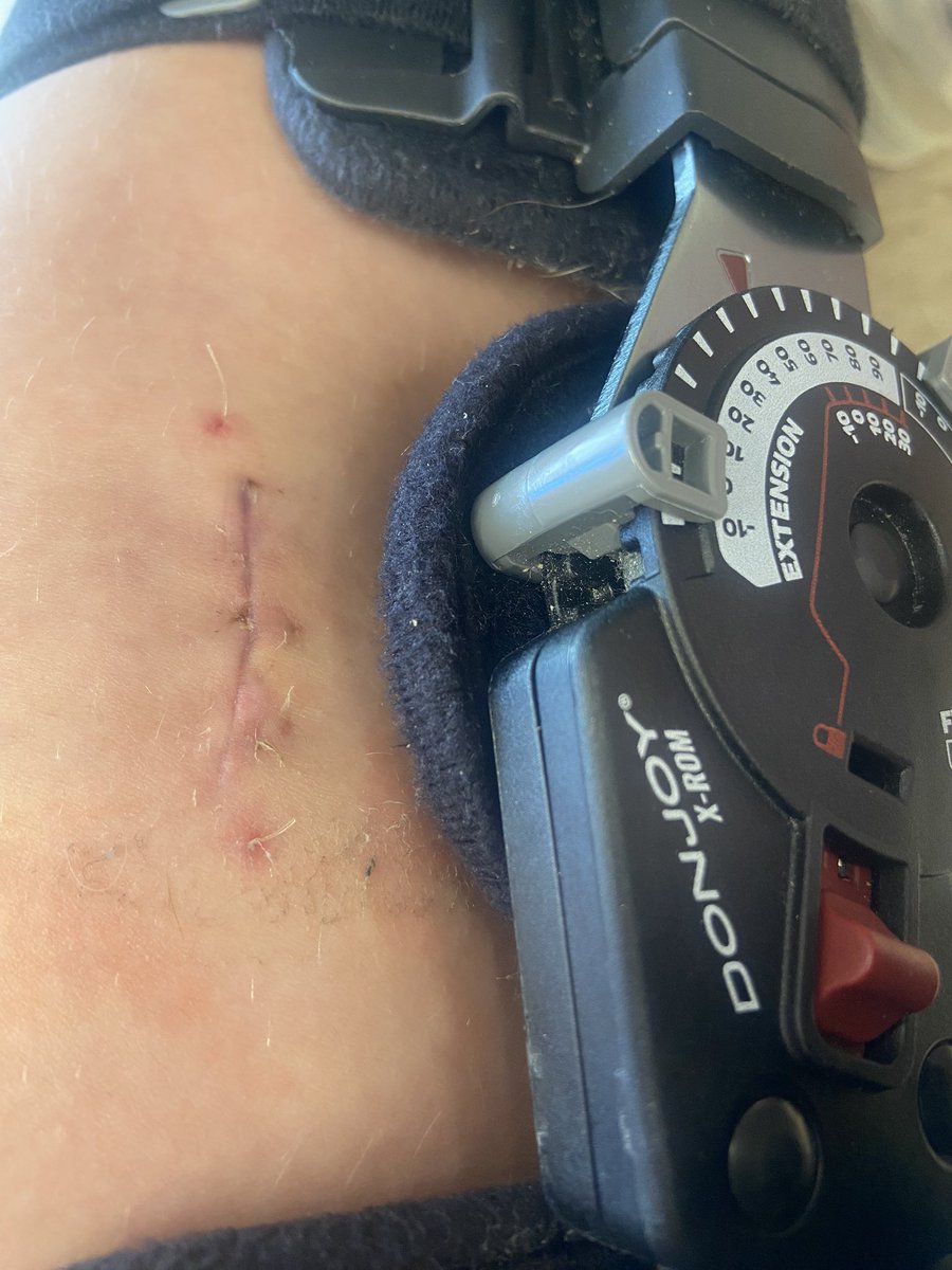 Almost 3 weeks post op. Got stitches out yesterday and am limited to bending my knee 90 degrees. Hoping to get back on the field soon!👏👏