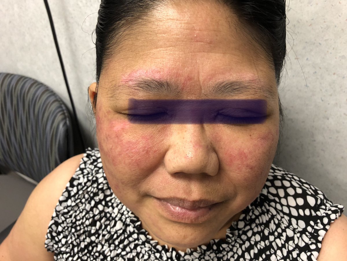 Janetbirdope's tweet photo. #RashWeek
#facial #lupus #rash https://t.co/f1cSaNlt8f